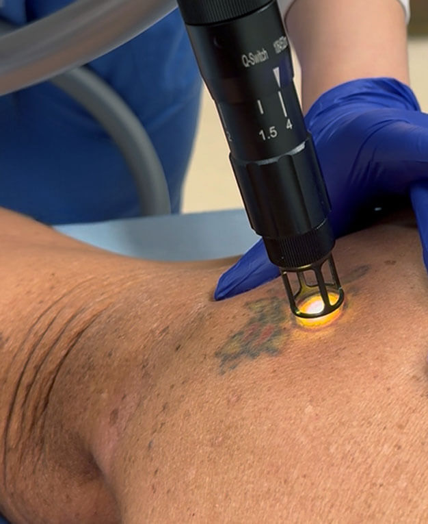 laser tattoo removal at nubody concepts nashville