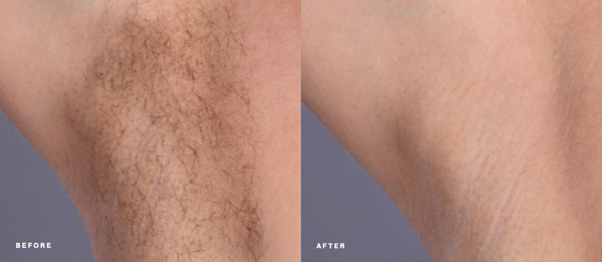 female laser hair removal before and after picture