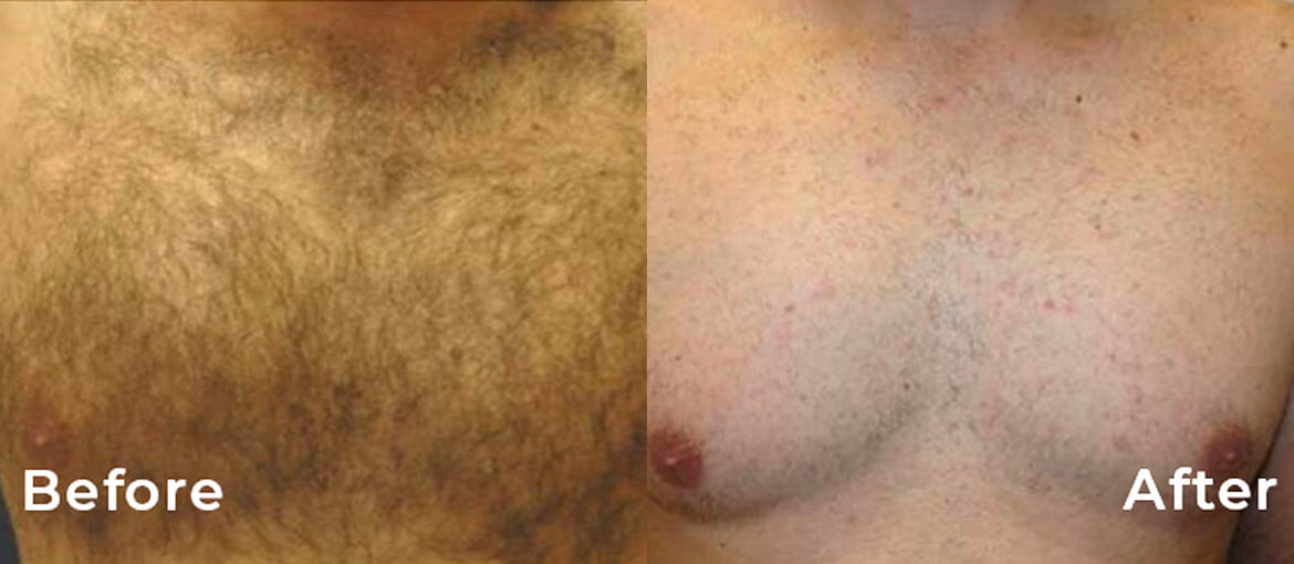 male laser hair removal before and after picture