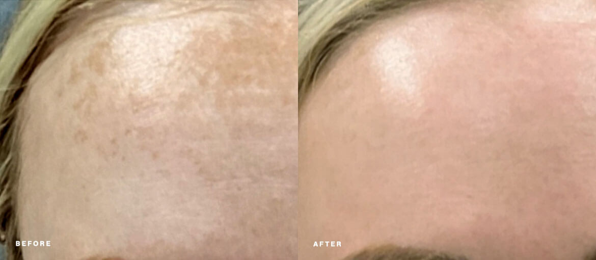 laser skin resurfacing before and after picture