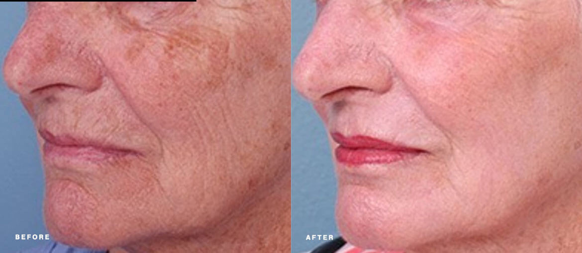 laser skin resurfacing before and after picture
