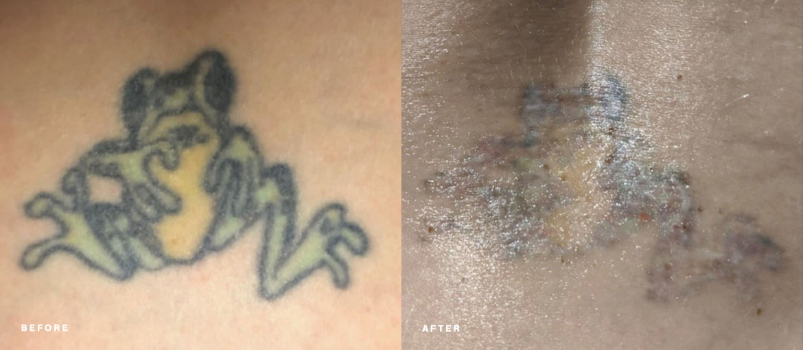 laser tattoo removal before and after picture