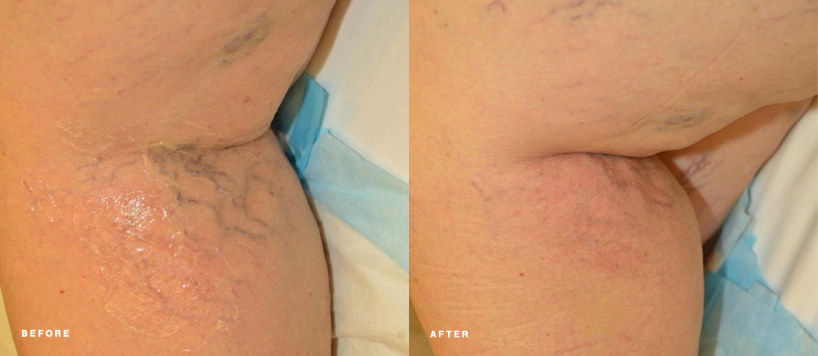 laser vein removal before and after picture