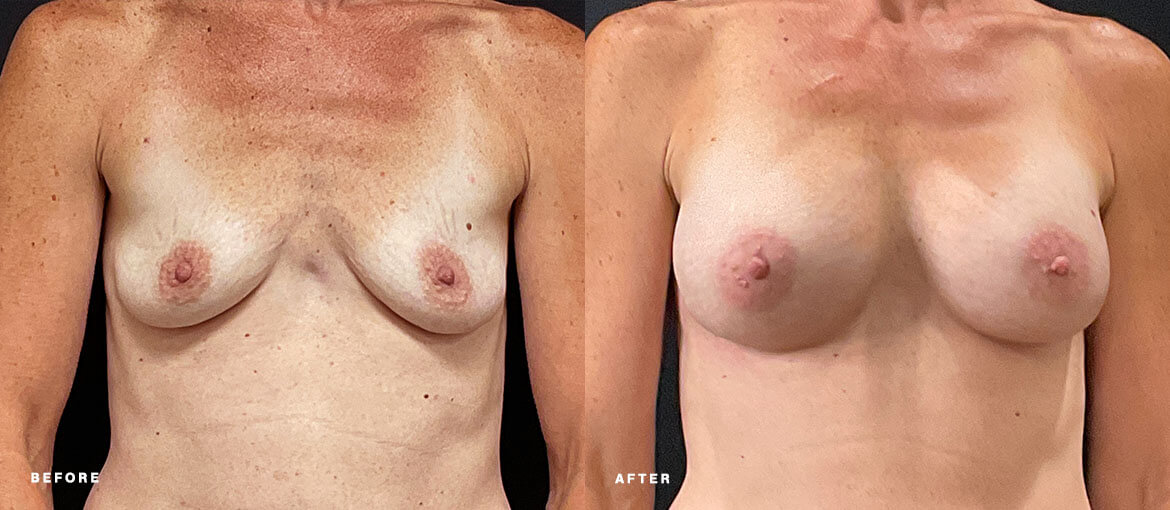 nubody concepts breast augmentation before and 6 months after procedure - front view