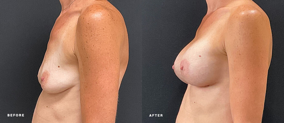 nubody concepts breast augmentation before and 6 months after procedure - left view