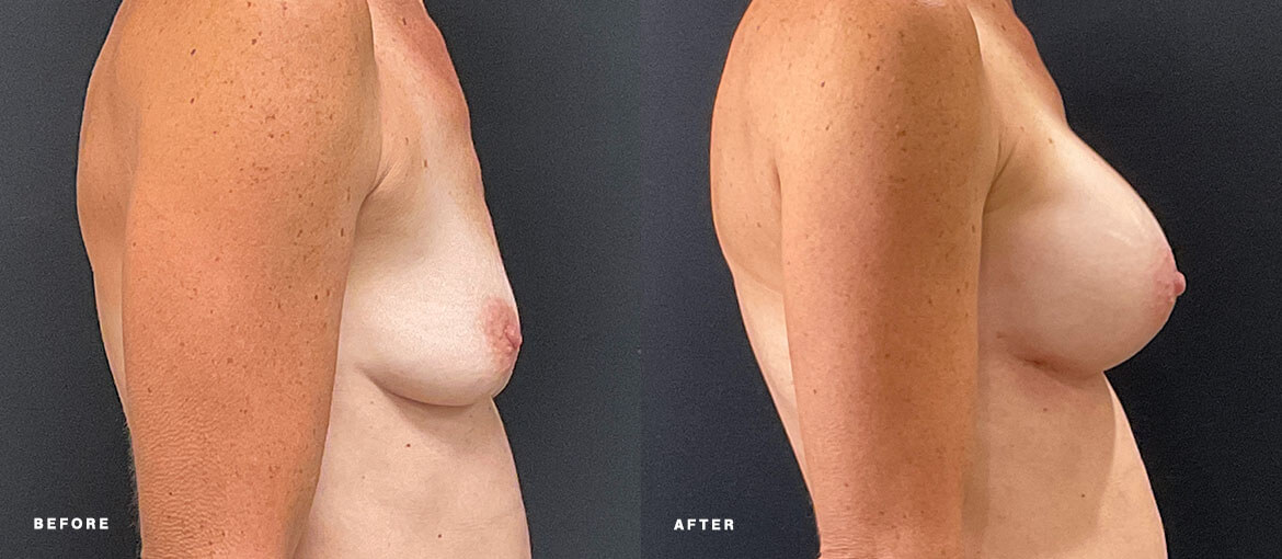 nubody concepts breast augmentation before and 6 months after procedure - right view