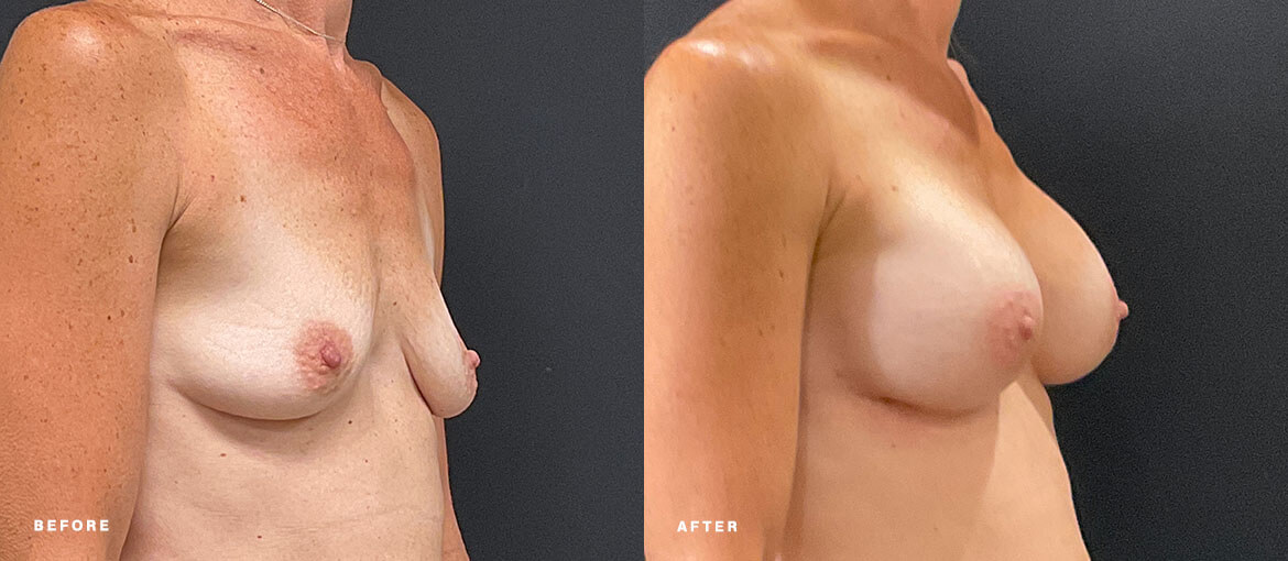 nubody concepts breast augmentation before and 6 months after procedure - right oblique view